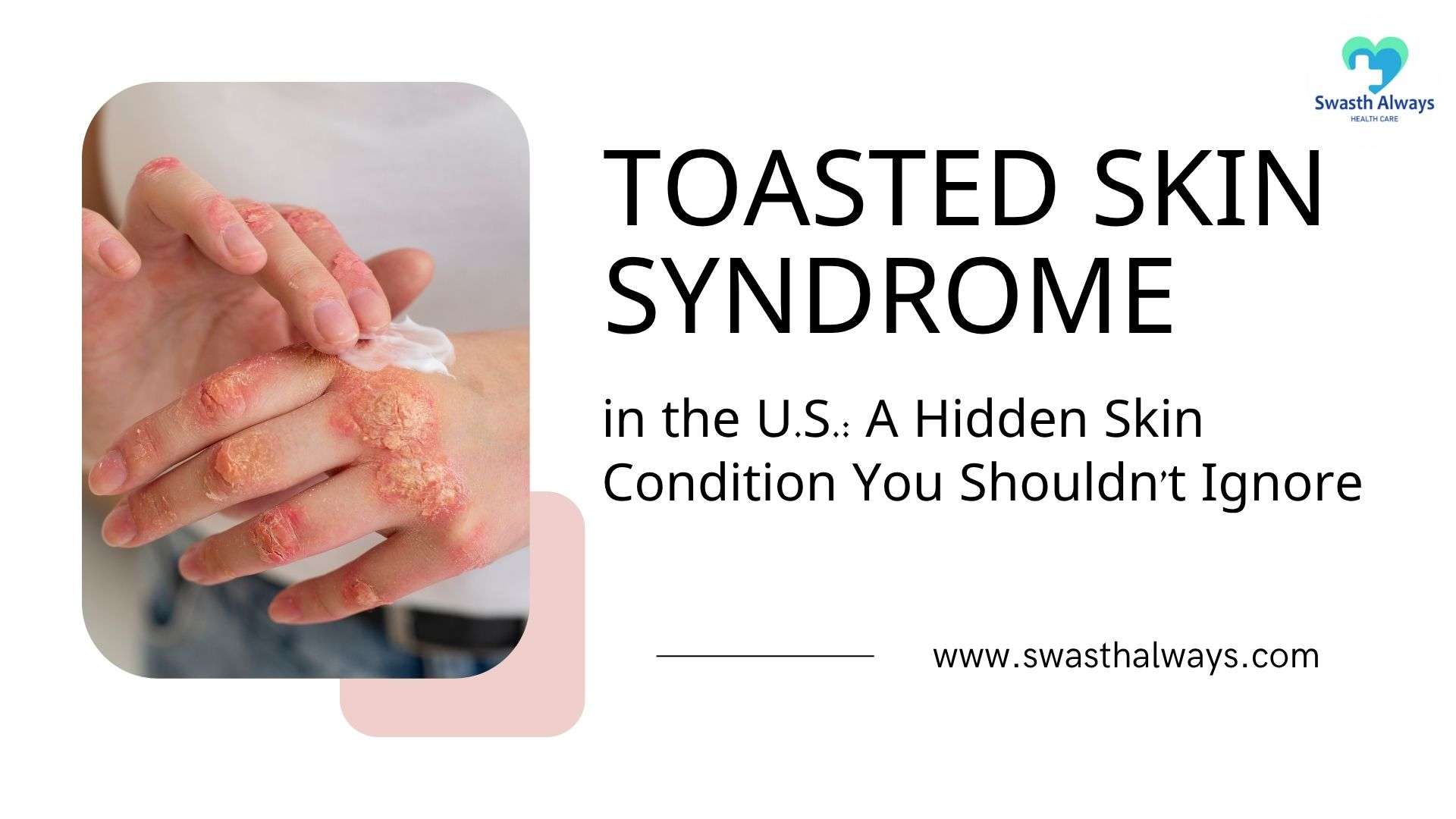 Toasted Skin Syndrome