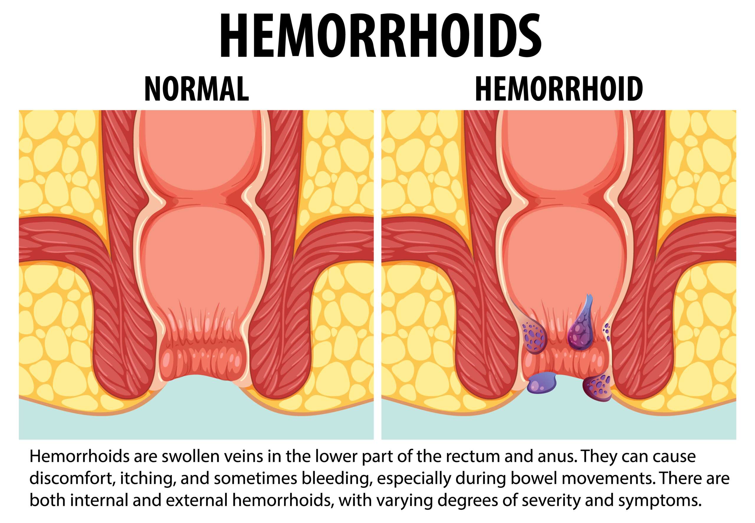 How do you prevent haemorrhoids or piles
