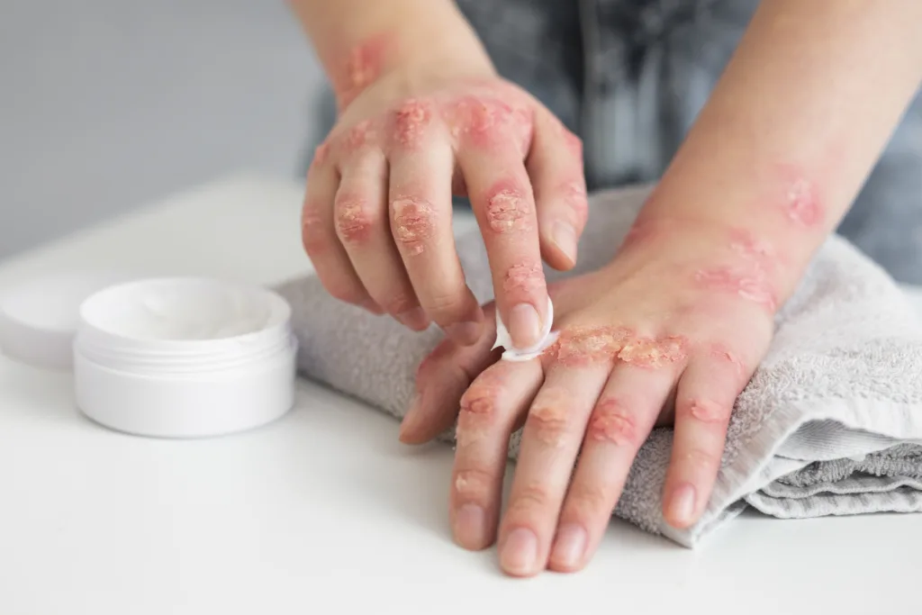 Dry skin and skin conditions on hands, covered in What Does Dry Skin Say About Your Health.